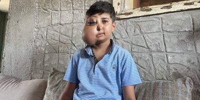 İki farklı yüzü var gibi görünen çocuğun tek isteği iyileşip gülmek