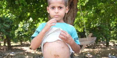 Köpeklerin saldırdığı çocuk 18 gün sonra taburcu oldu