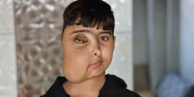 Enes gen tedavisiyle sağlığına kavuşacak