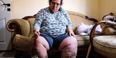 Adana’da lenfödem hastası anne tedavi için destek bekliyor
