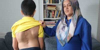 Adanalı 11 yaşındaki Cihan, skolyozla mücadele ediyor: Yeni ameliyat için destek bekliyor