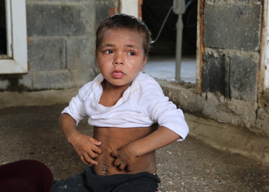 Balık pulu hastası kardeşler yardım bekliyor