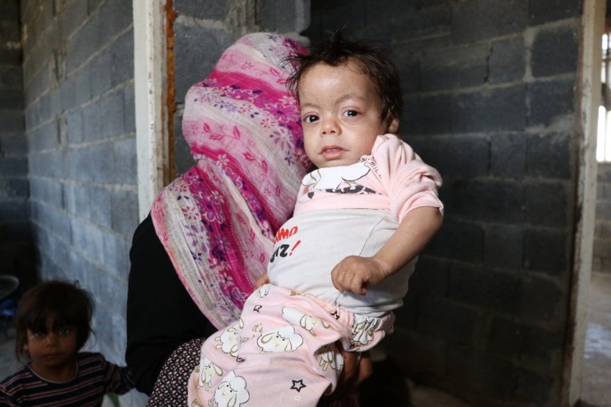 Balık pulu hastası kardeşler yardım bekliyor