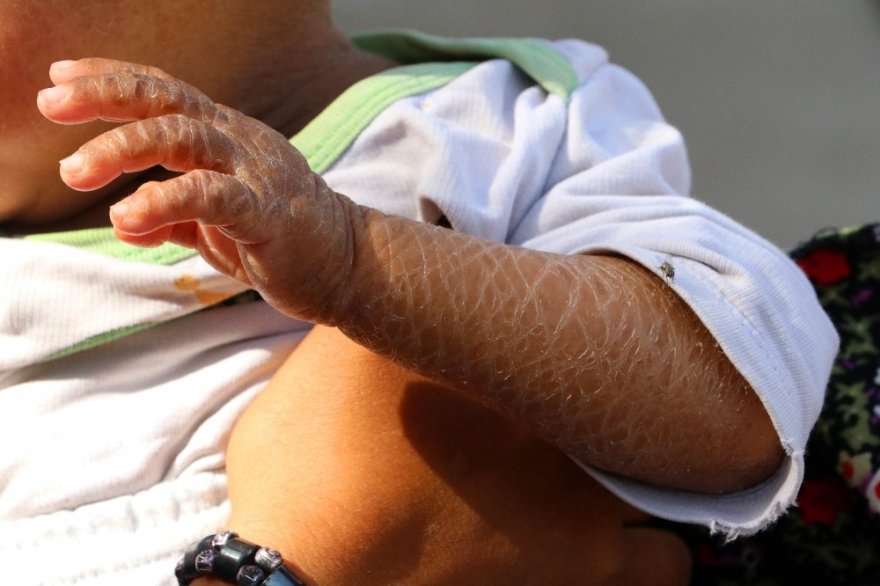 Balık pulu hastası kardeşler yardım bekliyor