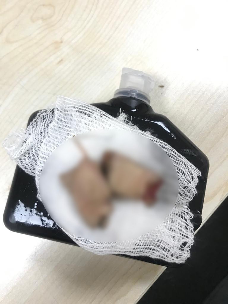 Elinde havai fişek patlayan adamın parmaklarını bulup dondurucuda sakladı