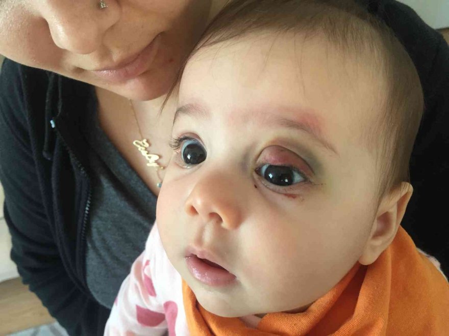 Göz kapağından ameliyat olan 7 aylık bebek bu hale geldi