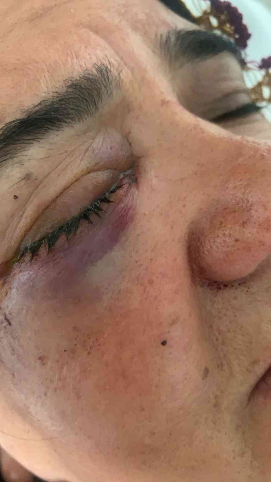 Pencereden bakarken gözüne saçma isabet etti