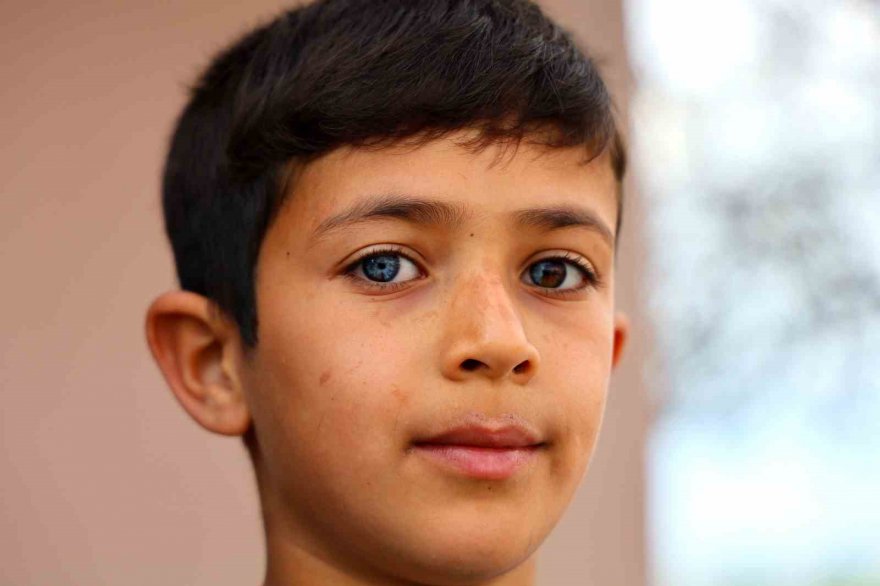 Hayata çift renk bakıyor, görenler hayrete düşüyor