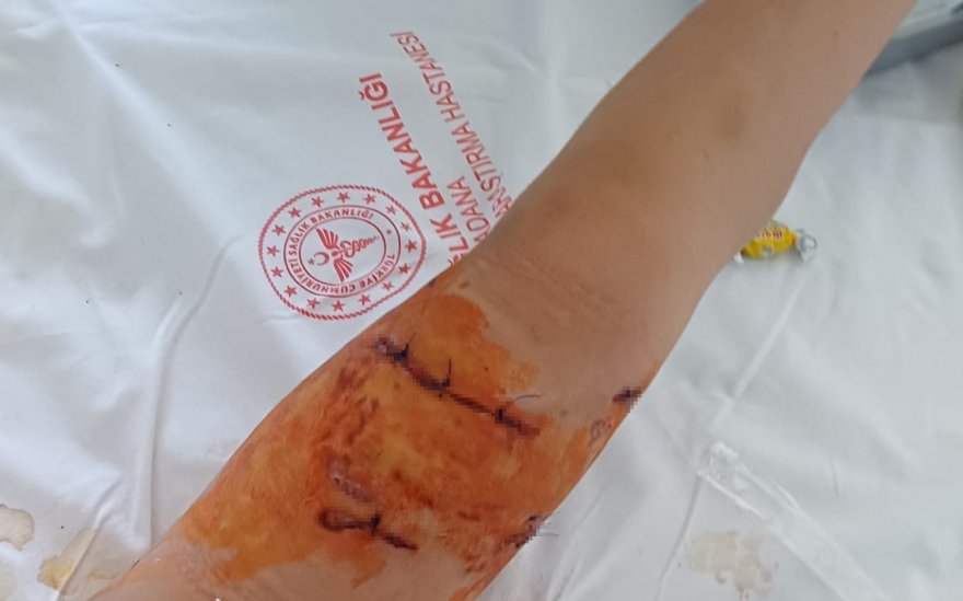 Köpeğin ısırdığı kız çocuğu: 